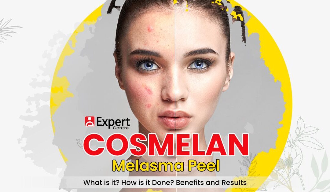 Cosmelan Melasma Peel: What is it? How is it Done? Benefits and Results