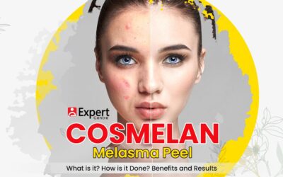 Cosmelan Melasma Peel: What is it? How is it Done? Benefits and Results