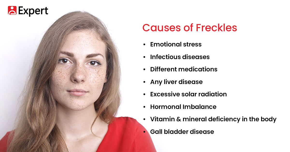 Causes of Freckles 