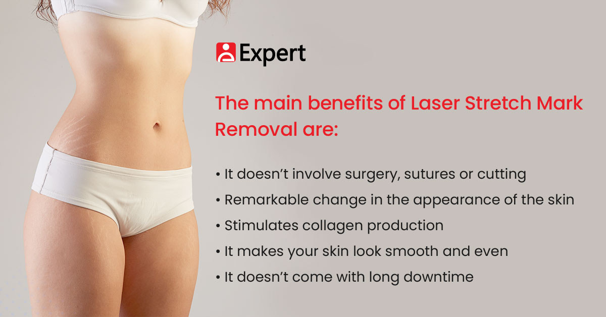 Benefits of Laser Stretch Mark Removal 