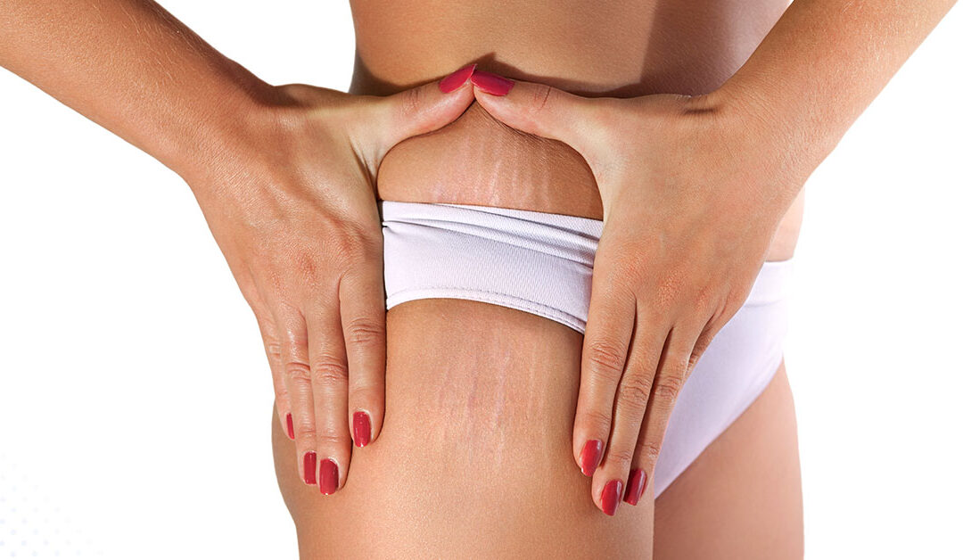 Everything you need to know about stretch mark removal treatment