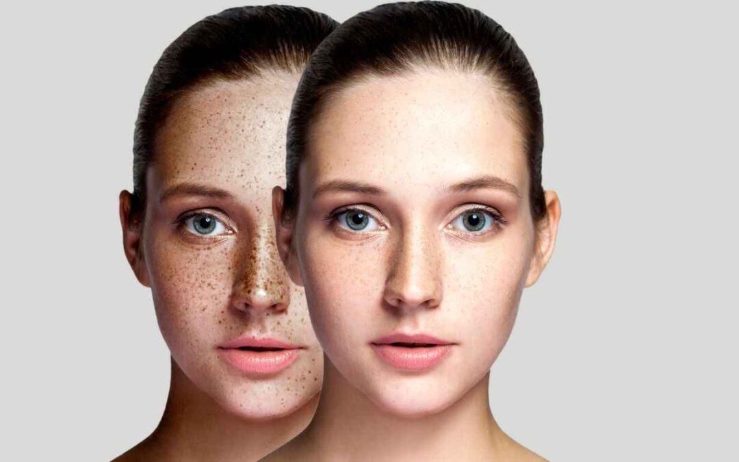 Can freckles be removed by laser?