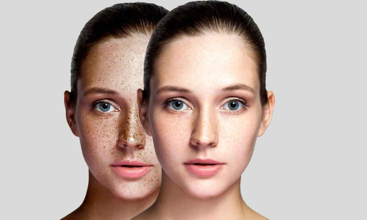 How To Remove Freckles Fast With Laser Treatment Expert Centre 7160