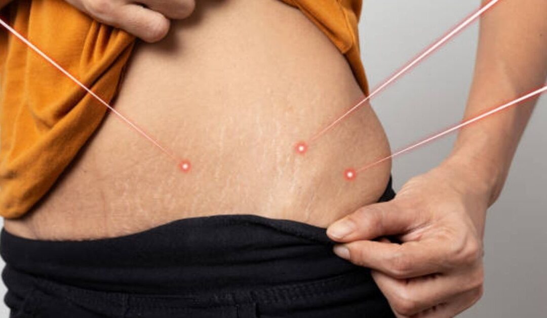 laser stretch mark removal treatment in london