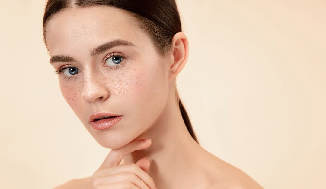Can You Get Rid of Freckle Speckles?