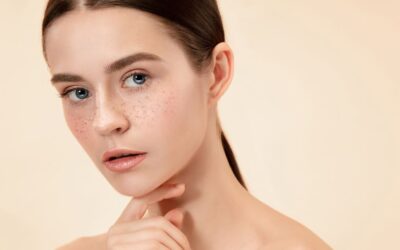 Can You Get Rid of Freckle Speckles?