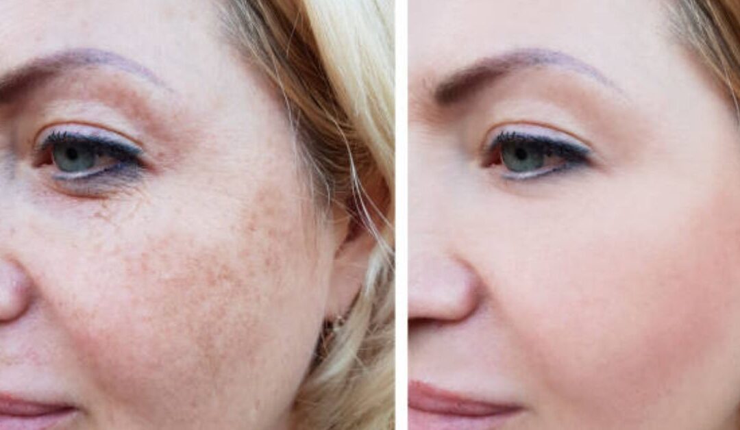 skin pigmentation treatment options