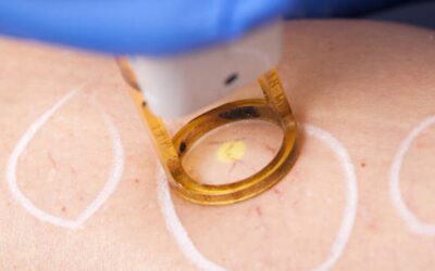 What to expect from your Laser Vein Removal Procedure?
