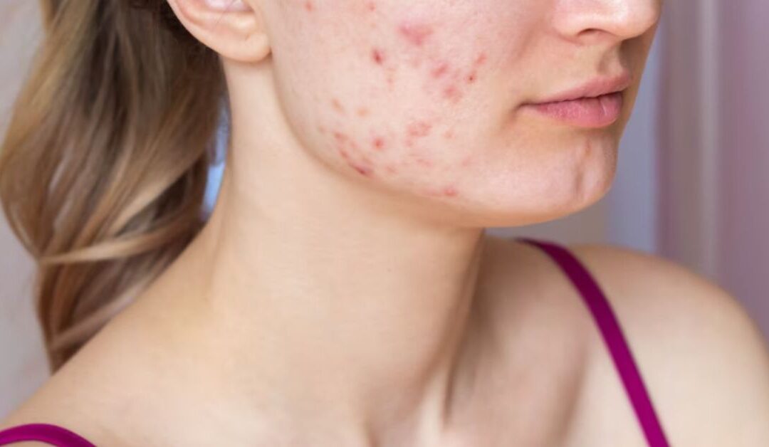 What Causes Cystic Acne in Women