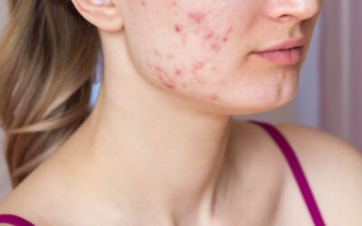 What Causes Cystic Acne in Women?