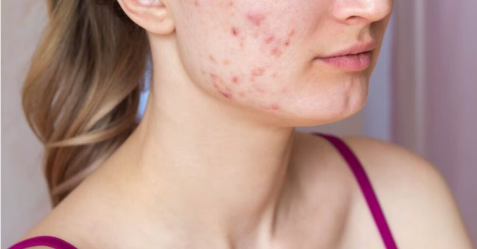 what-causes-cystic-acne-in-women-expert-centre