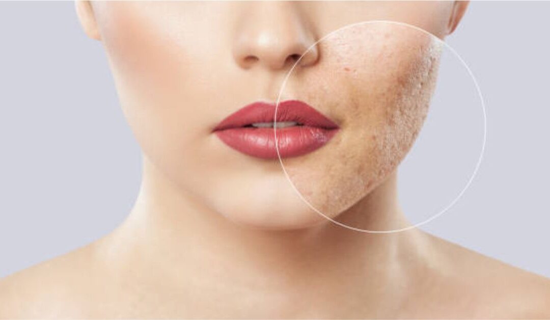 home remedies to treat acne scars