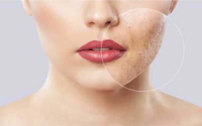 Home Remedies To Treat Acne Scars
