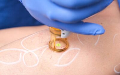 Uncovering the Benefits of Laser Treatment for Spider Veins
